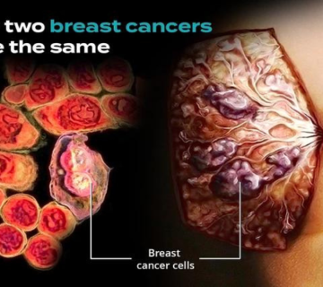 تشخیص سرطان پستان: دیدگاه ژنتیکی