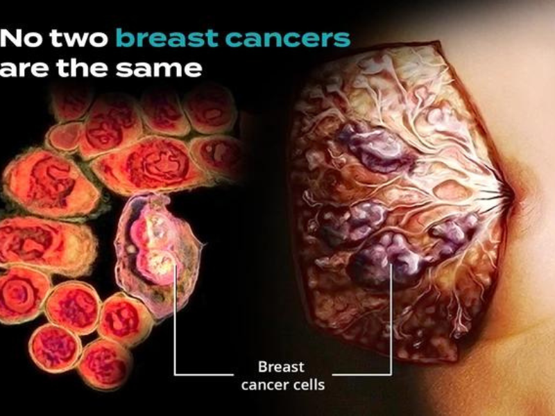 تشخیص سرطان پستان: دیدگاه ژنتیکی