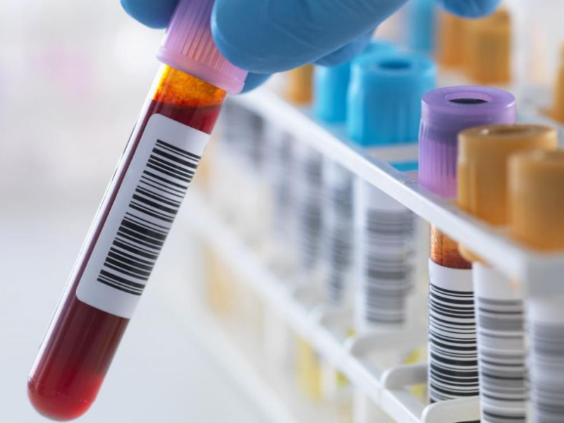 نکات کلیدی قبل از انجام تست آلرژی RAST 1 نکات کلیدی قبل از انجام تست آلرژی RAST