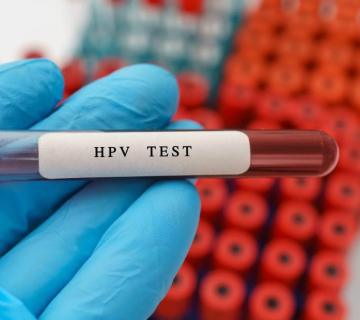 هر آنچه درباره نمونه گیری HPV باید بدانیم 7 هر آنچه درباره نمونه گیری HPV باید بدانیم