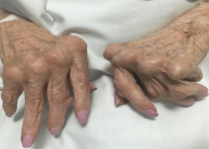 آزمایش اینترلوکین-۶ یا IL-6 سایتوکاینی چیست؟ 2 آزمایش اینترلوکین-۶ یا IL-6 سایتوکاینی چیست؟