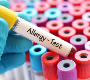 آزمایش RAST آلرژی چیست؟