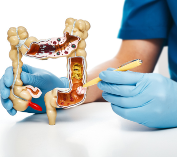 چه آزمایش هایی برای غربالگری سرطان روده وجود دارد؟